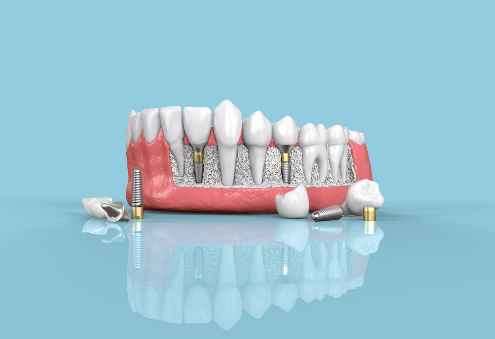 Know about Dental Implants