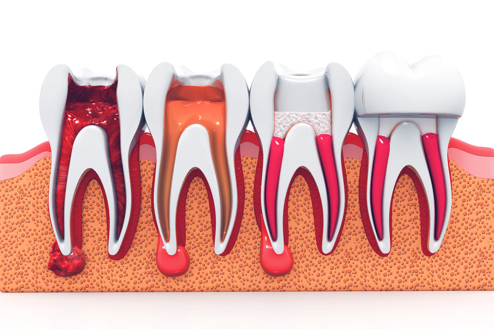 Know about Root Canal Treatment