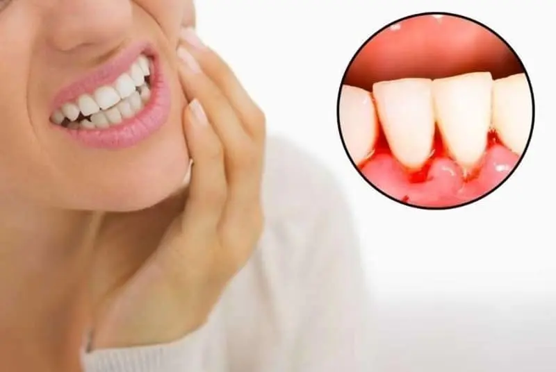 Bleeding Gum Treatment