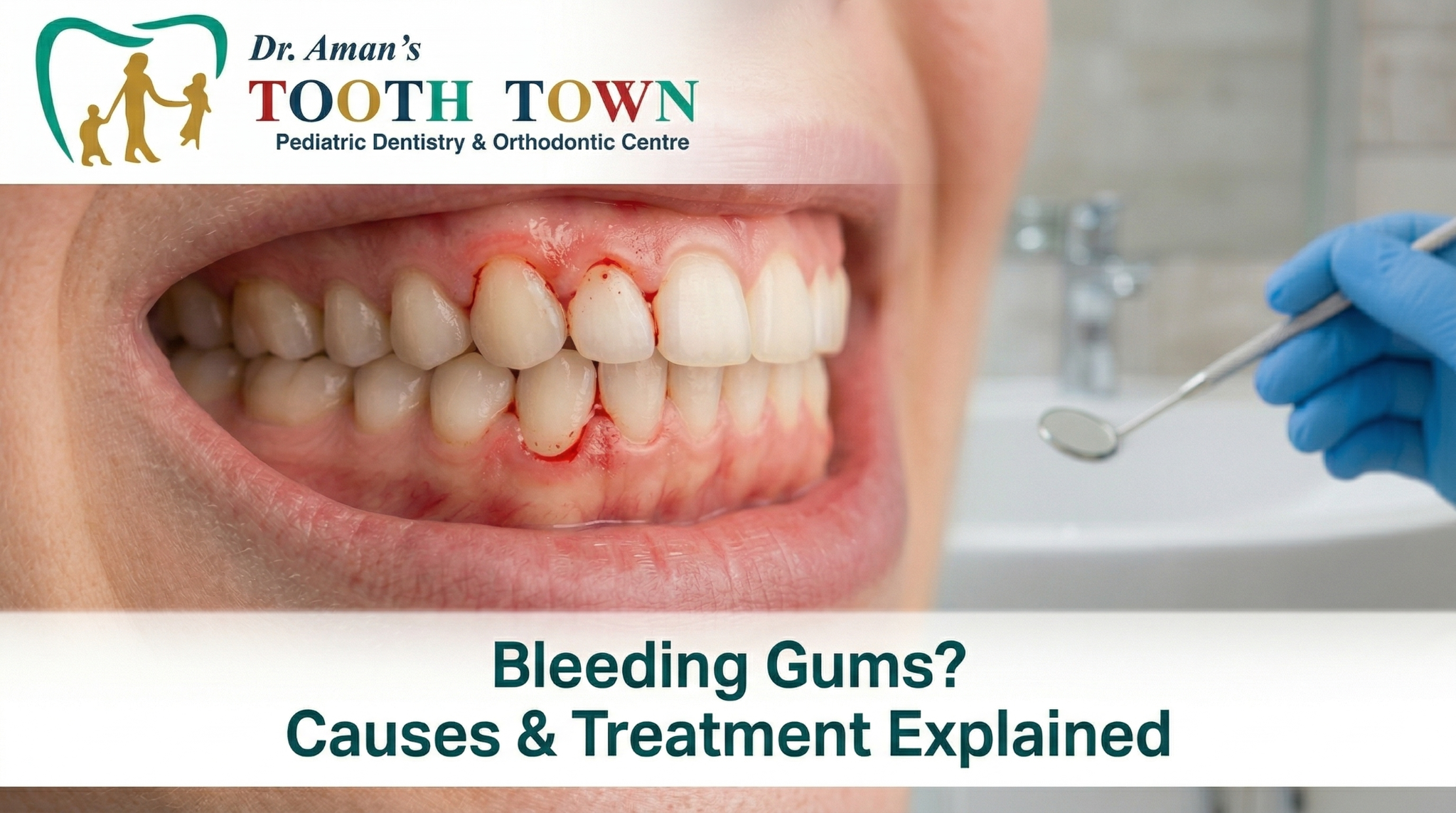Stop Gingivitis: Bleeding Gums Treatment | Tooth-Town
