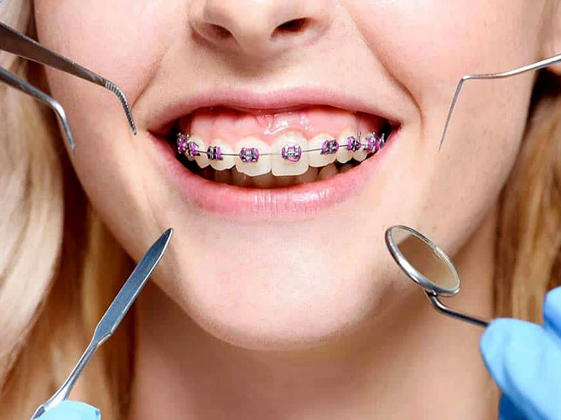 Braces Treatment