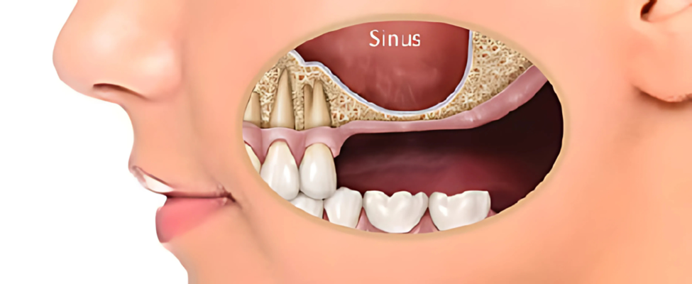 Preparing for Dental Implants: What to Expect and How to Get Ready