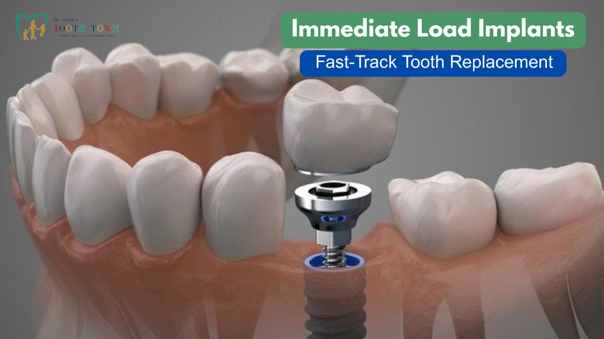 Immediate Load Implants | Tooth Town
