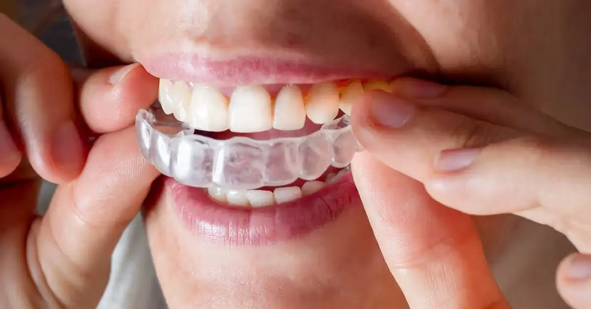 Invisalign Near Me