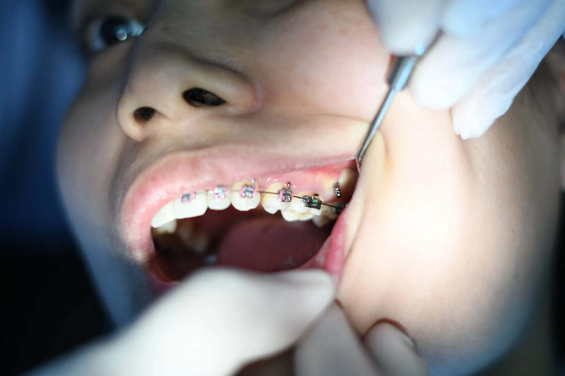 Orthodontic Treatment