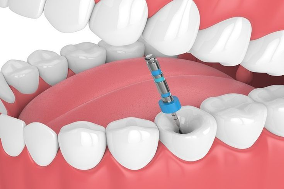 Root Canal Treatment in Vasant Vihar – Gentle Dental Care