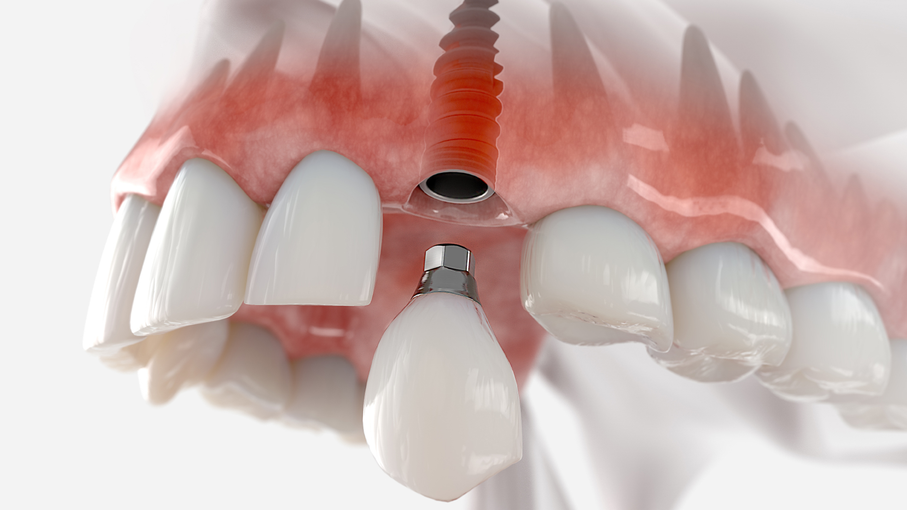 What are immediate load implants?