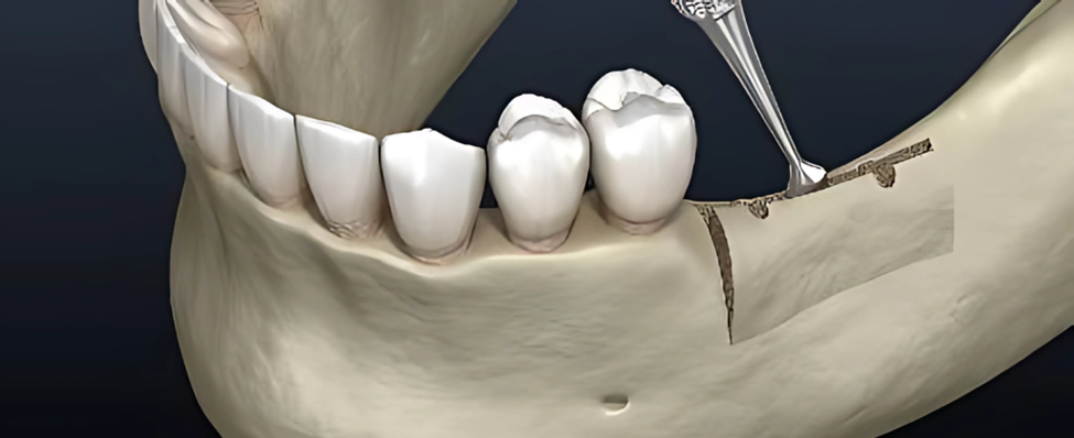 What Is Ridge Augmentation?