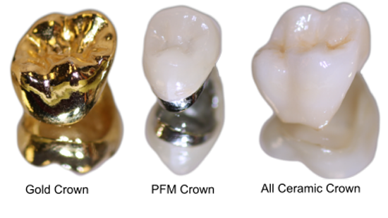 Best Dental Crowns in Delhi
