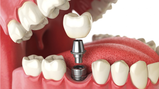 Dental implants Cost in Delhi