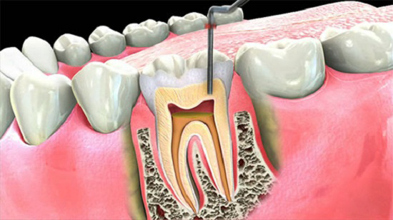 Root Canal treatments