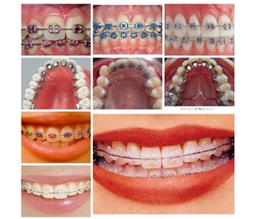 Braces